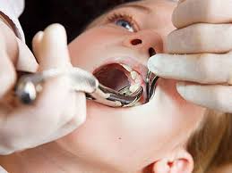 Tooth-Extraction 