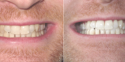 laser teeth whitening Dr Dennis Mexico