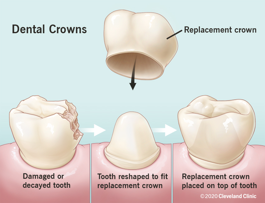 What is a Dental Crown Dr Dennis Mexico
