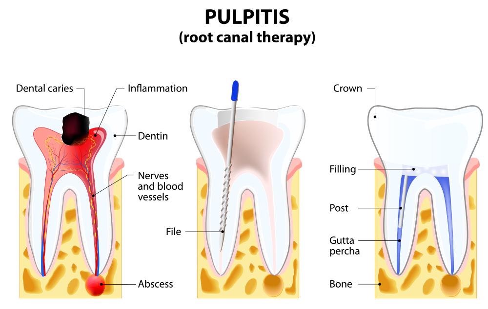Things to Know Before Having a Root Canal