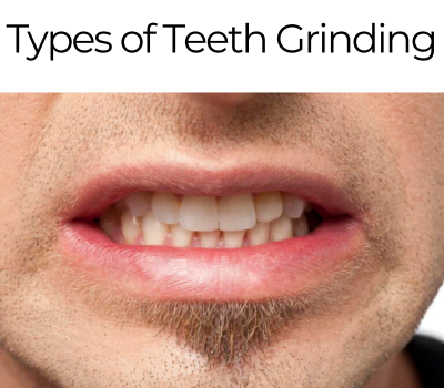 Types of teeth grinding
