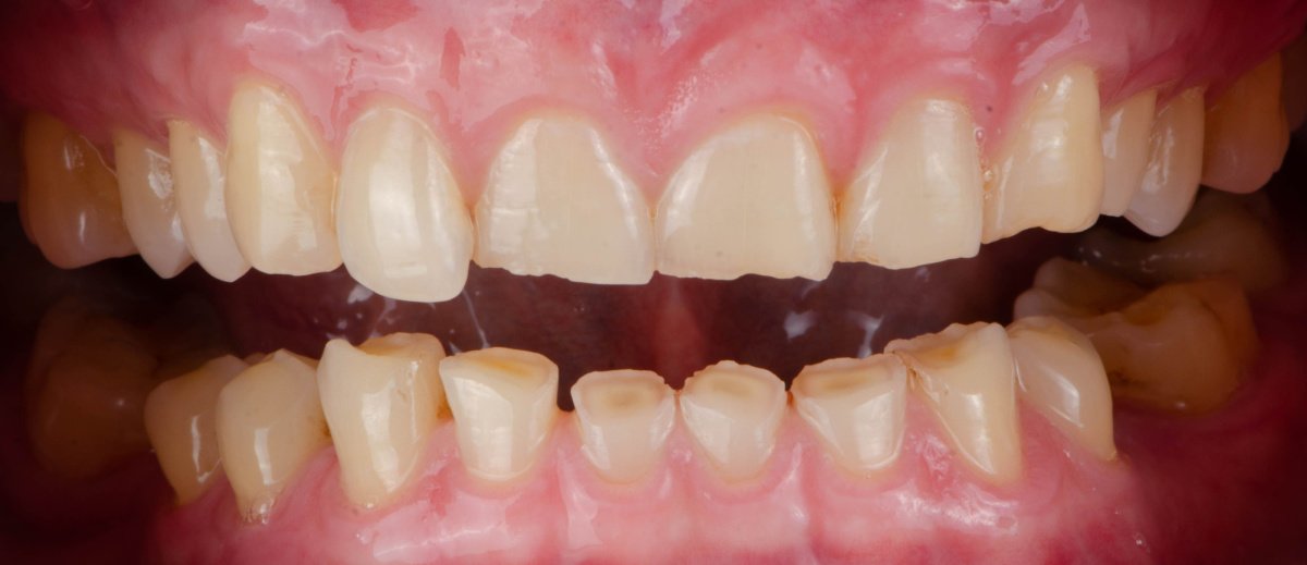 bruxism-tooth-wear