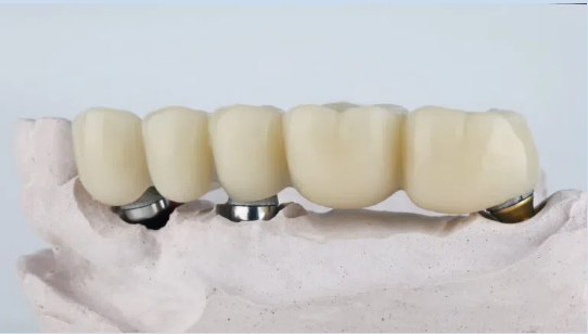 Multiple-tooth implant