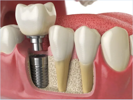 Single-tooth implant 