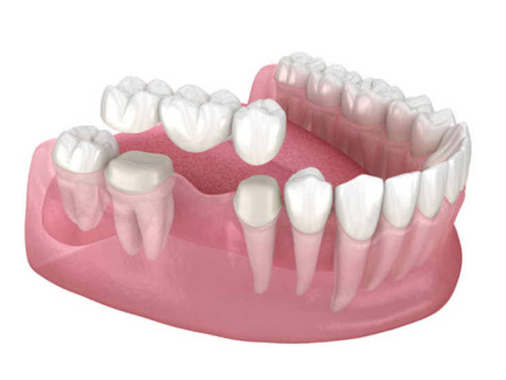 Prepare the teeth around the Dental Bridge