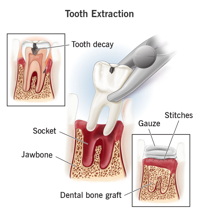 toothecay extraction